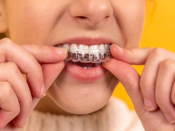 dental-appliances-mercato-dental-centre-in-east-vancouver