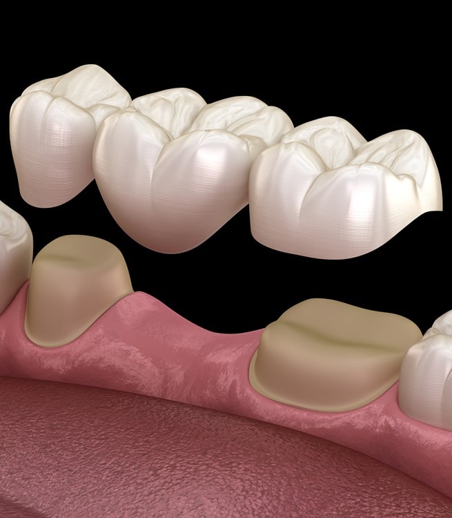 dental-bridges-mercato-dental-centre-in-east-vancouver