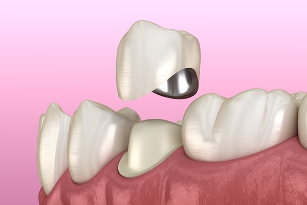 dental-crowns-mercato-dental-centre