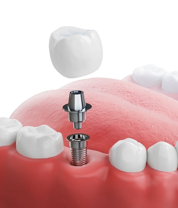 dental-implants-mercato-dental-centre-in-east-vancouver