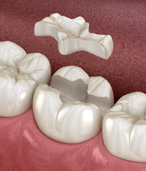 inlays-and-onlays-mercato-dental-centre-in-east-vancouver