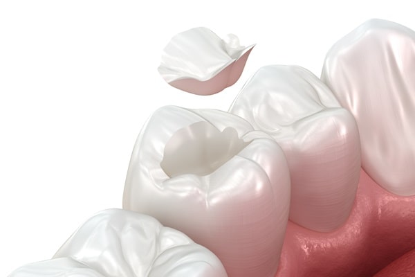 inlays-and-onlays-mercato-dental-centre