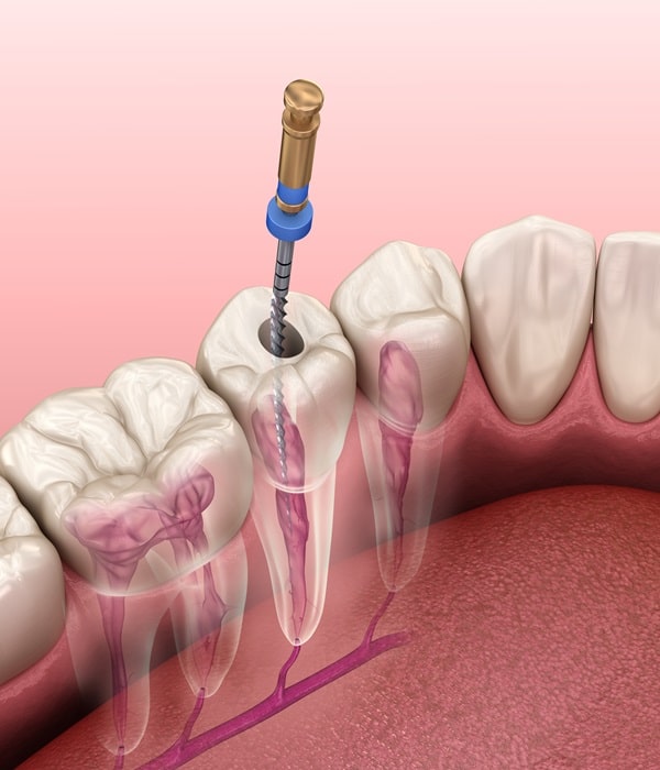 root-canals-mercato-dental-centre-in-east-vancouver