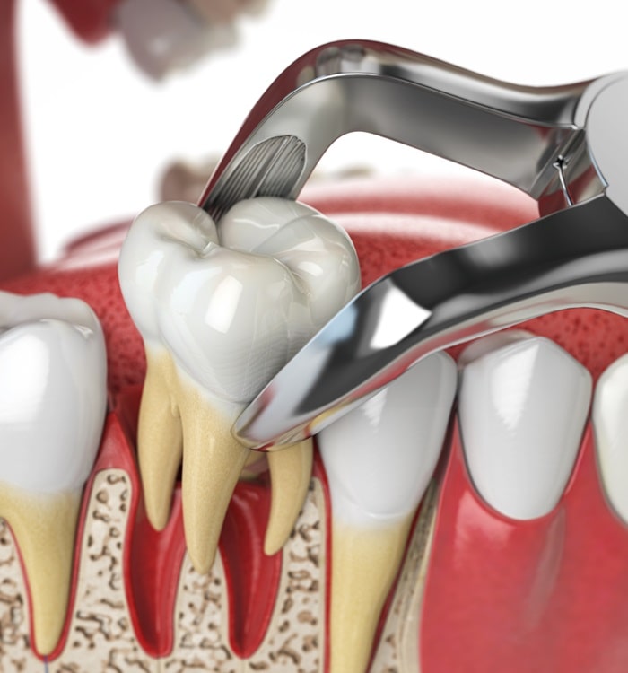 teeth-extractions-mercato-dental-centre-in-east-vancouver