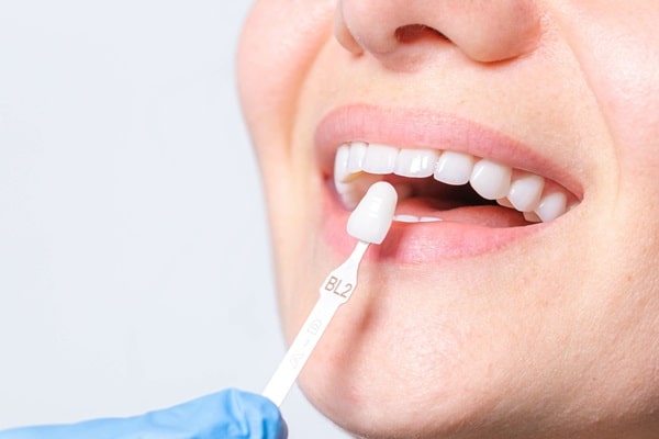 veneers-mercato-dental-centre